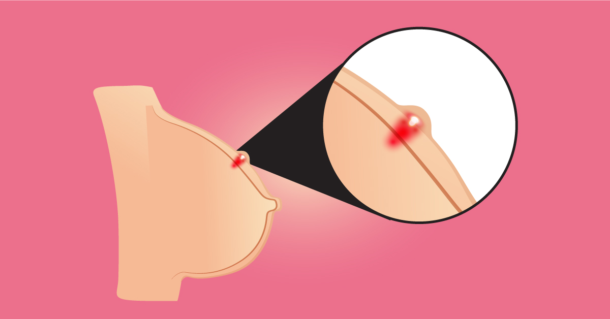 10 Jenis Kanker yang Paling Umum dan Cara Mengenalinya